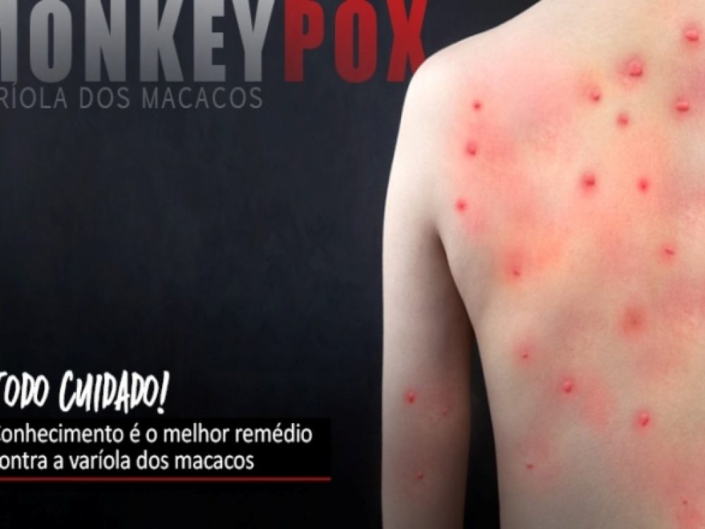 26072022_Saúde_variola-dos-macacos_ Site